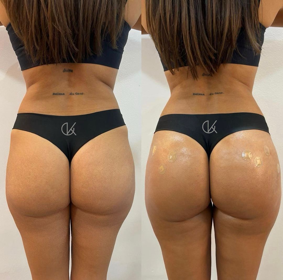 Fios de Sustentação